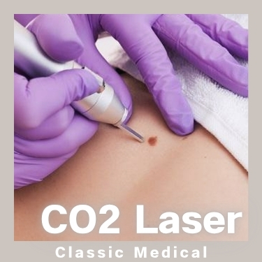 二氧化碳CO2激光脫癦/脫疣